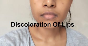 Home Remedies for Discoloration Of Lips