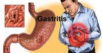 Home Remedies for Gastritis