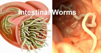 Home Remedies for Intestinal Worms