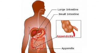 Home Remedies for Appendicitis