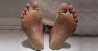 Home Remedies for Athlete’s Foot