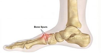 Home Remedies for Bone Spur