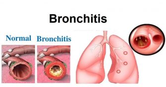 Home Remedies for Bronchitis