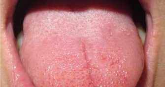 Home Remedies for Burning Tongue