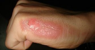 Home Remedies for Burns