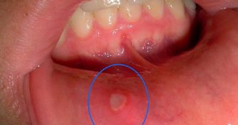 Home Remedies for Canker Sores