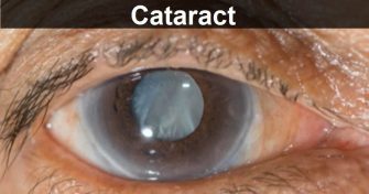 Home Remedies for Cataract