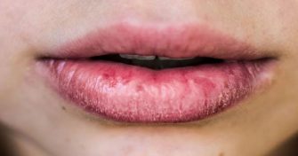 Home Remedies for Dry Chapped Lips