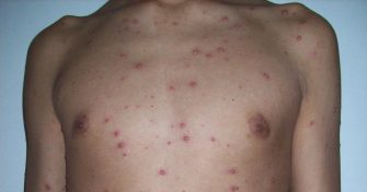 Home Remedies for Chicken Pox