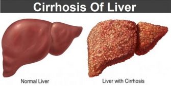 Home Remedies for Cirrhosis Of Liver