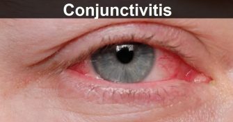 Home Remedies for Conjunctivitis