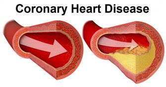 Home Remedies for Coronary Heart Disease