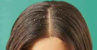 Home Remedies for Dandruff