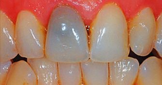 Home Remedies for Discoloration Of Teeth