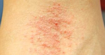 Home Remedies for Eczema