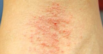 Home Remedies for Eczema