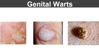 Home Remedies for Genital Warts