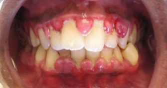 Home Remedies for Gingivitis