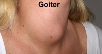 Home Remedies for Goiter