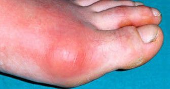 Home Remedies for Gout