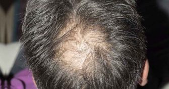 Home Remedies for Hair Loss