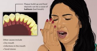 Home Remedies for Halitosis