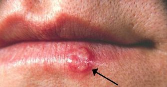 Home Remedies for Herpes