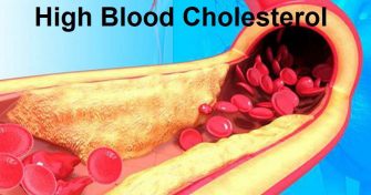 Home Remedies for High Blood Cholesterol