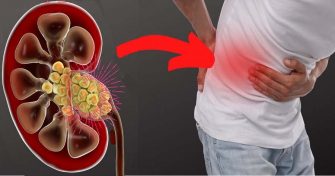 Home Remedy for Kidney Stones