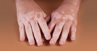 Home Remedies for Leucoderma