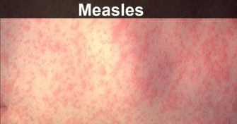 Home Remedies for Measles