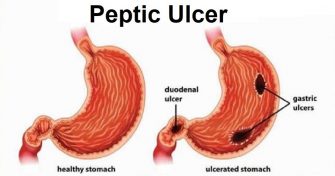 Home Remedies for Peptic Ulcer