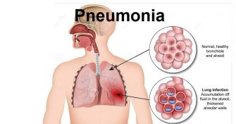 Home Remedies for Pneumonia