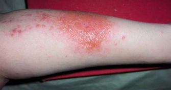 Home Remedies for Poison Ivy