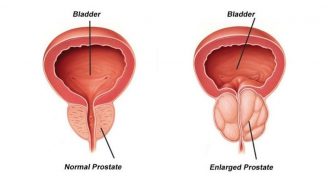 Home Remedies for Prostate Disorders
