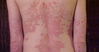 Home Remedies for Psoriasis