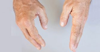 Home Remedies for Rheumatism