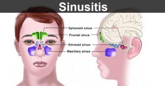 Home Remedies for Sinusitis