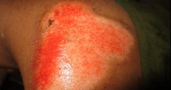 Home Remedies for Skin Abrasion