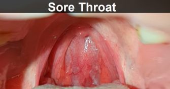 Home Remedies for Sore Throat