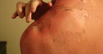 Home Remedies for Sunburn