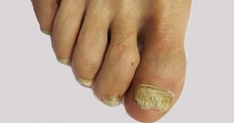 Home Remedies for Toe Nail Fungus