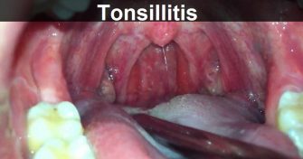 Home Remedies for Tonsillitis