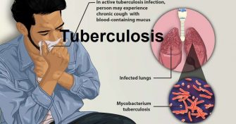 Home Remedies for Tuberculosis