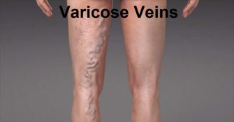 Home Remedies for Varicose Veins