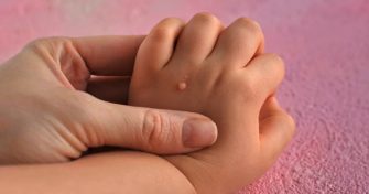 Home Remedies for Warts