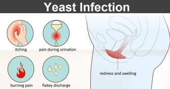 Home Remedies for Yeast Infection